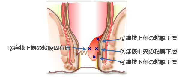 痔核(いぼ痔)のALTA注射療法(ジオン)