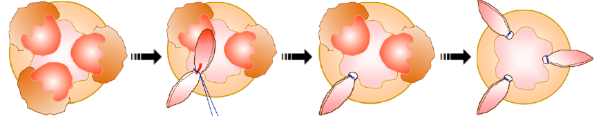 結紮切除術