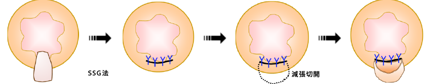 肛門形成術(SSG法)