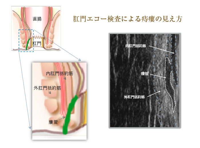 肛門エコー検査による痔瘻の見え方