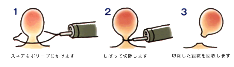 隆起しているポリープの場合