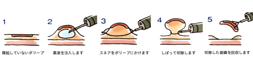 平坦型ポリープの場合