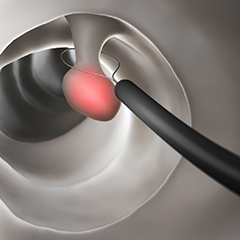 日帰りポリープ切除