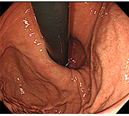 食道裂孔ヘルニア