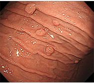 胃底腺ポリープ