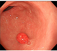 過形成ポリープ