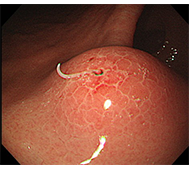 胃アニサキス症