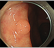 大腸ポリープ