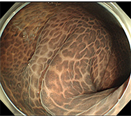 大腸メラノーシス